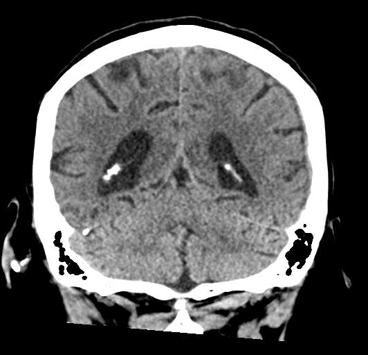 File:Acute traumatic subdural hematoma (Radiopaedia 82921-97257 Coronal non-contrast 60).jpg