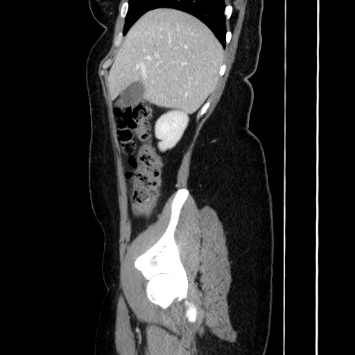 Acute uncomplicated appendicitis (Radiopaedia 73704-84499 Sagittal C+ portal venous phase 69).jpg