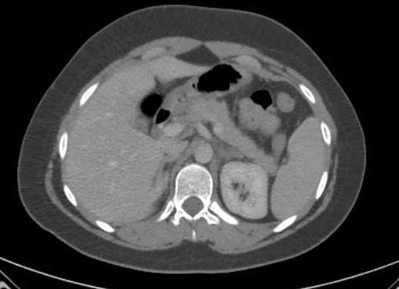Acute unilateral nonhemorrhagic adrenal infarction (Radiopaedia 67560-76957 Axial renal parenchymal phase 34).jpg