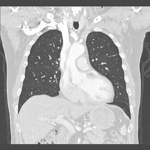 Adenocarcinoma of the lung (Radiopaedia 59871-67325 Coronal lung window 21).jpg