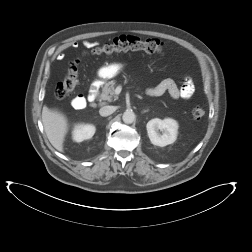 Adenocarcioma of rectum- T1 lesion (Radiopaedia 36921-38547 Axial C+ portal venous phase 31).png