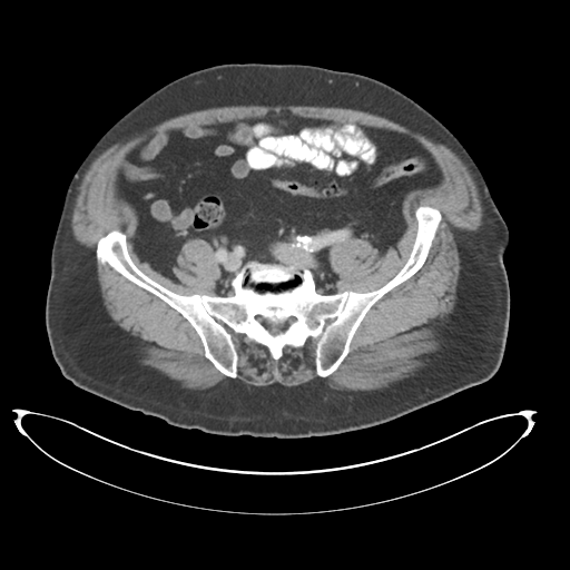 Adenocarcioma of rectum- T1 lesion (Radiopaedia 36921-38547 Axial C+ portal venous phase 65).png