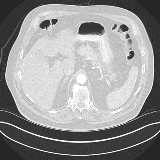 Adenocarcioma of rectum- T1 lesion (Radiopaedia 36921-38547 Axial lung window 55).png