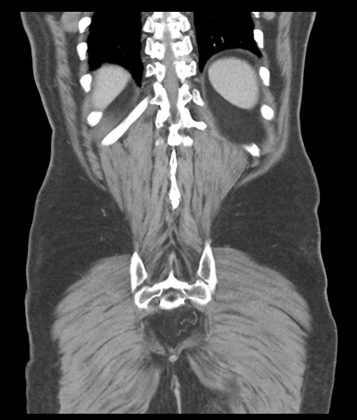 Adenocarcioma of rectum- T1 lesion (Radiopaedia 36921-38547 Coronal C+ portal venous phase 53).png