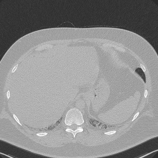 Adenoid cystic carcinoma of the trachea (Radiopaedia 49042-54137 Axial lung window 306).jpg