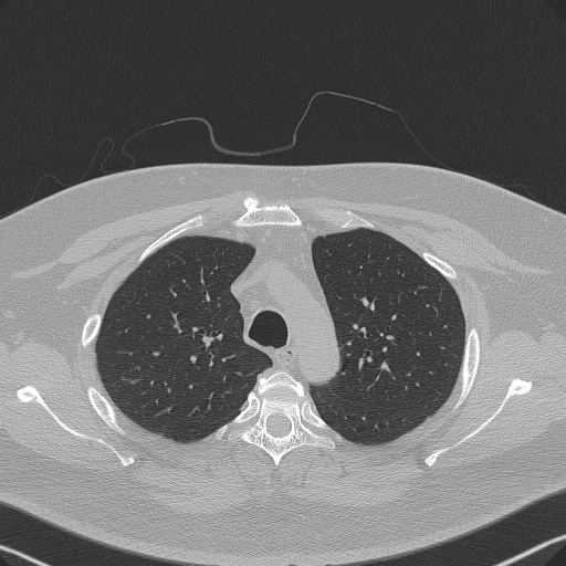 Adenoid cystic carcinoma of the trachea (Radiopaedia 49042-54137 Axial lung window 91).jpg