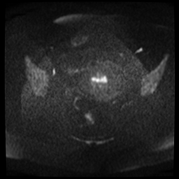 File:Adenomyosis-scar endometriosis (Radiopaedia 65863-75022 Axial DWI 8).jpg