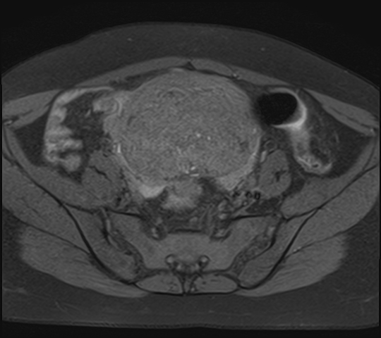 File:Adenomyosis - ovarian endometriomas (Radiopaedia 67031-76350 Axial T1 fat sat 9).jpg