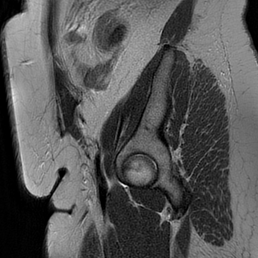 File:Adenomyosis within a didelphys uterus (Radiopaedia 70175-80215 Sagittal T2 2).jpg