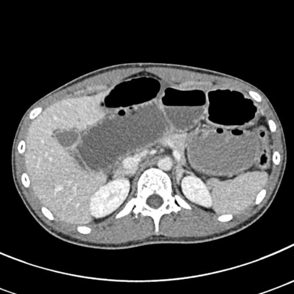 File:Adhesional small bowel obstruction (Radiopaedia 52107-57980 Axial C+ portal venous phase 30).jpg