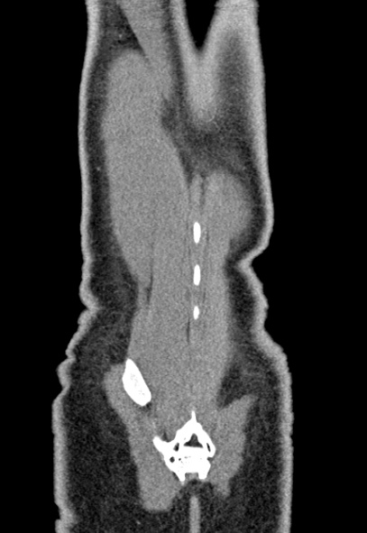 Adhesional small bowel obstruction (Radiopaedia 52107-57980 Coronal C+ portal venous phase 78).jpg