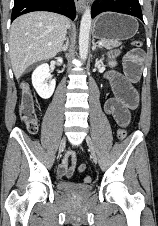 Adhesional small bowel obstruction (Radiopaedia 58900-66131 Coronal C+ portal venous phase 157).jpg