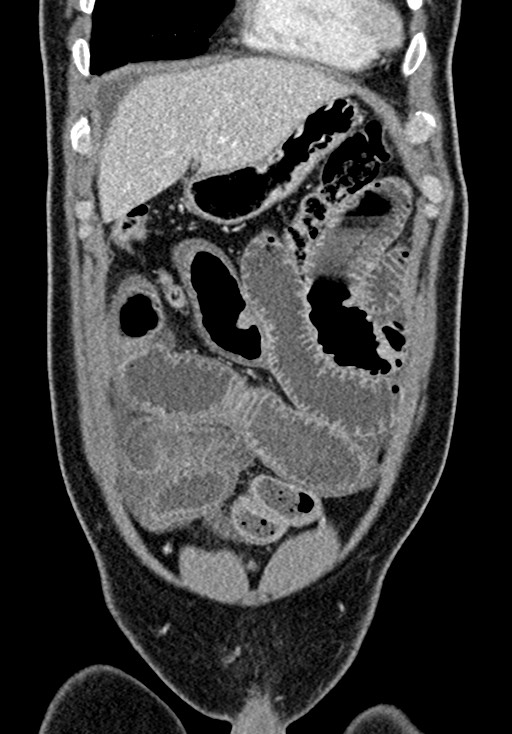 Adhesional small bowel obstruction (Radiopaedia 58900-66131 Coronal C+ portal venous phase 85).jpg