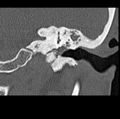 File:Adhesive chronic otitis media (Radiopaedia 14270-14148 Coronal bone window - left 16).jpg