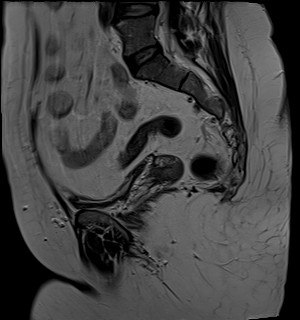 File:Adnexal multilocular cyst (O-RADS US 3- O-RADS MRI 3) (Radiopaedia 87426-103754 Sagittal T2 9).jpg