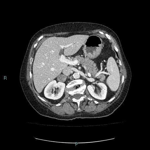 File:Adrenal collision tumor (ACT) (Radiopaedia 48462-53379 Axial C+ portal venous phase 16).jpg