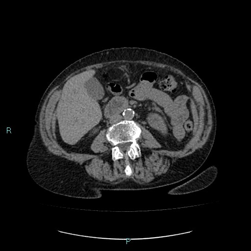 File:Adrenal collision tumor (ACT) (Radiopaedia 48462-53379 Axial non-contrast 30).jpg