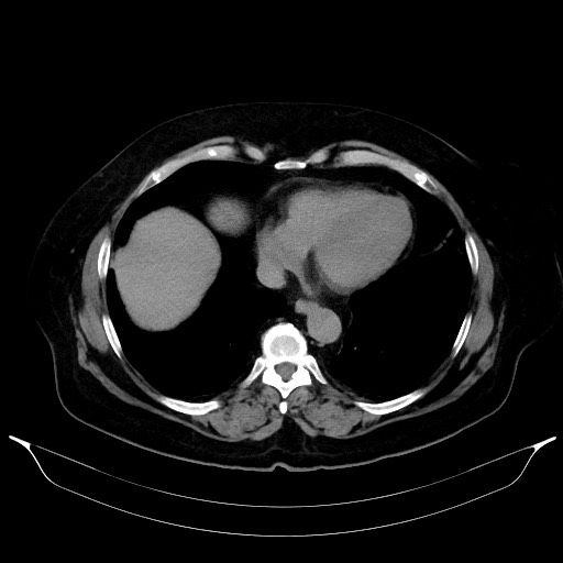 Adrenal cortical carcinoma (Radiopaedia 64017-72769 Axial C+ delayed 7).jpg
