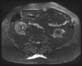 Adrenal cortical carcinoma (Radiopaedia 64017-72770 Axial DWI 77).jpg