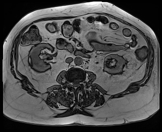 File:Adrenal cortical carcinoma (Radiopaedia 64017-72770 Axial T1 out-of-phase 50).jpg