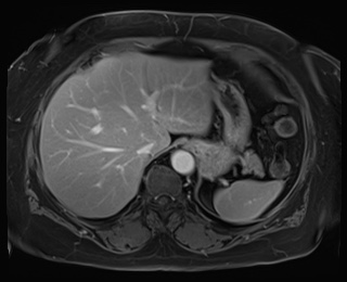 Adrenal cortical carcinoma (Radiopaedia 64017-72770 J 15).jpg