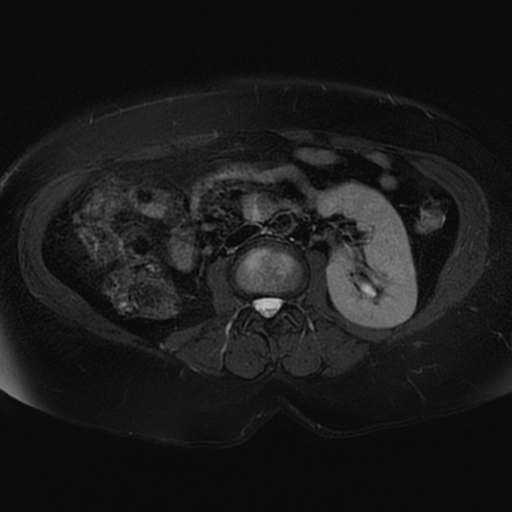 File:Adrenal cortical carcinoma (Radiopaedia 70906-81116 Axial T2 fat sat 34).jpg