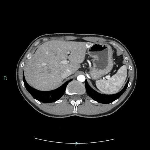 Adrenal cystic lymphangioma (Radiopaedia 83161-97534 Axial C+ arterial phase 23).jpg