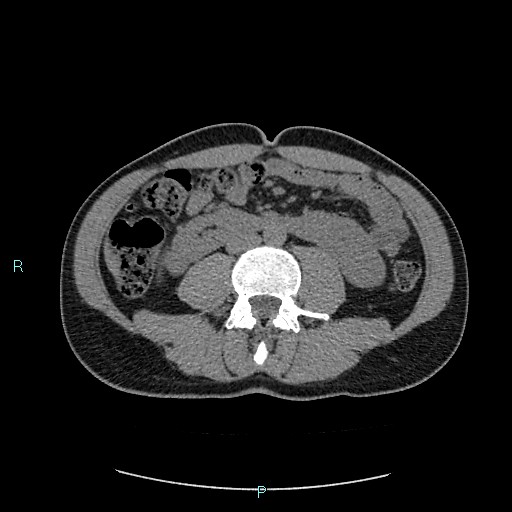 Adrenal cystic lymphangioma (Radiopaedia 83161-97534 Axial non-contrast 53).jpg