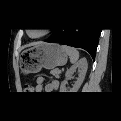Adrenal gland trauma (Radiopaedia 81351-95079 Sagittal non-contrast 73).jpg