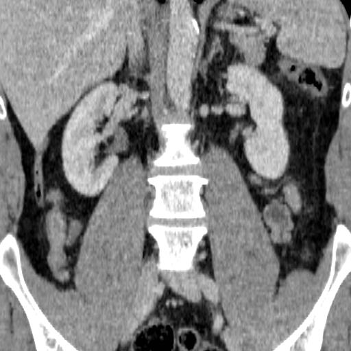File:Adrenal glands (normal CT anatomy) (Radiopaedia 16570-105725 Coronal 5).jpg