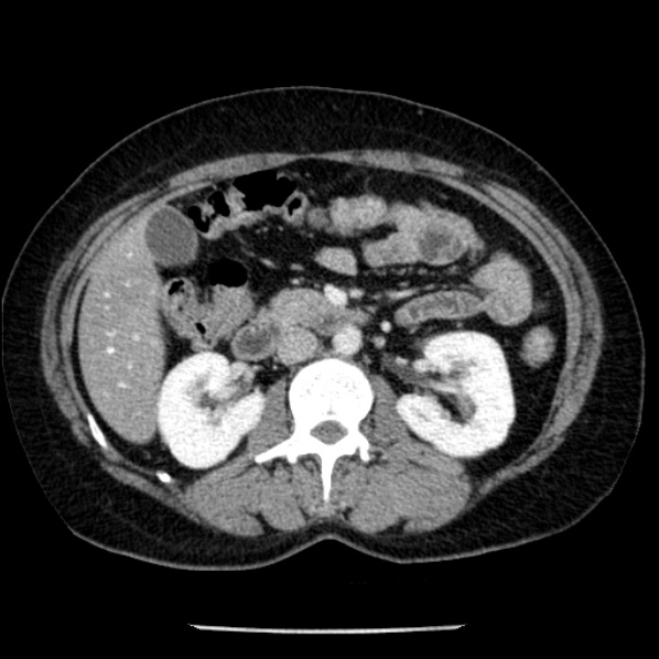 Adrenal myelolipoma (Radiopaedia 43401-46759 Axial C+ portal venous phase 37).jpg