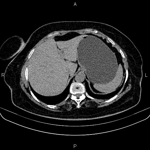 Adrenal myelolipoma (Radiopaedia 82742-96986 Axial non-contrast 25).jpg