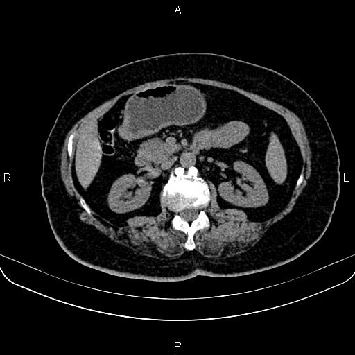 File:Adrenal myelolipoma (Radiopaedia 82742-96986 Axial non-contrast 66).jpg