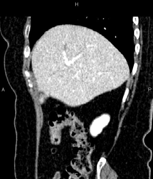 File:Adrenal myelolipoma (Radiopaedia 82742-96986 Sagittal renal cortical phase 29).jpg
