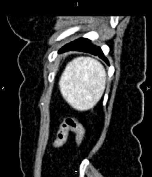 Adrenal myelolipoma (Radiopaedia 82742-96986 Sagittal renal cortical phase 95).jpg