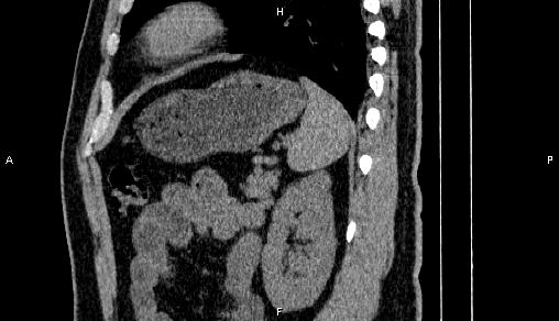 File:Adrenal myelolipoma (Radiopaedia 84321-99619 Sagittal non-contrast 81).jpg