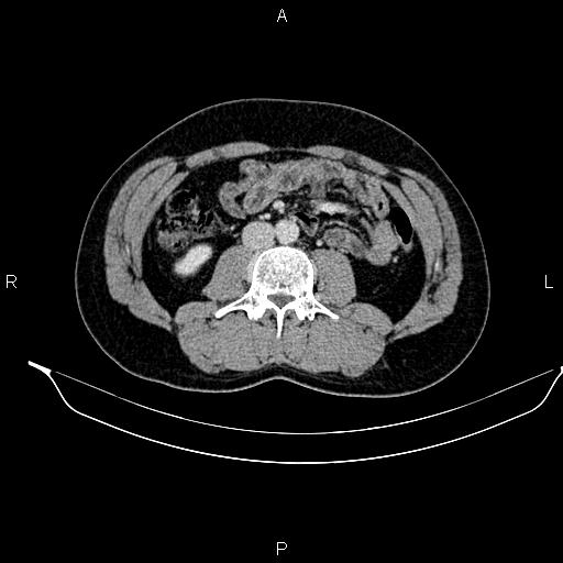 Adrenal myelolipoma (Radiopaedia 87794-104246 Axial renal cortical phase 56).jpg