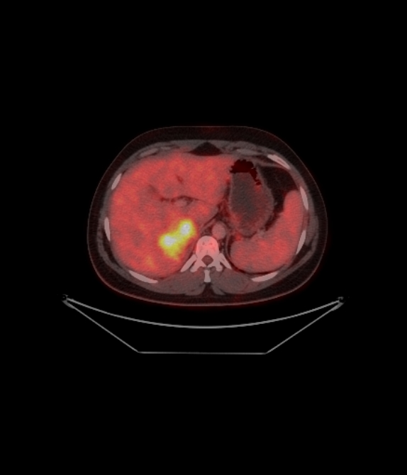 Adrenocortical carcinoma (Radiopaedia 80134-93440 ِAxial 152).jpg