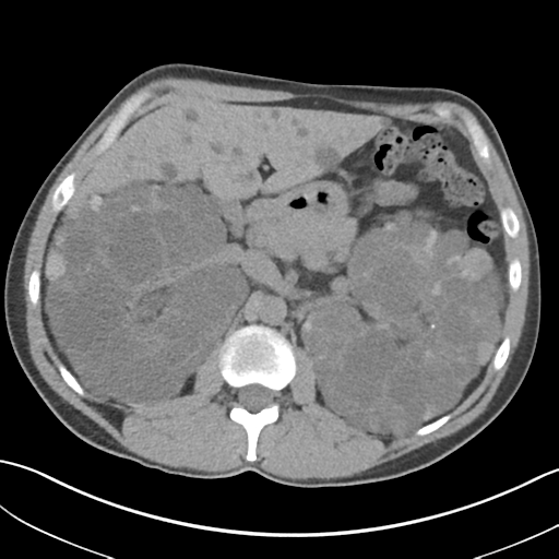 File:Adult polycystic kidney disease (Radiopaedia 47866-52626 Axial non-contrast 27).png