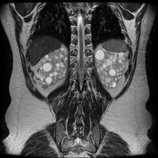 Adult polycystic kidney disease (Radiopaedia 48845-53876 Axial renal cortical phase 23).jpg