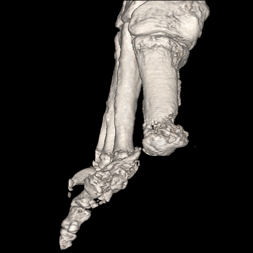 File:Advanced osteomyelitis due to open metatarsal fracture (Radiopaedia 83891-99095 VRT 8).jpg