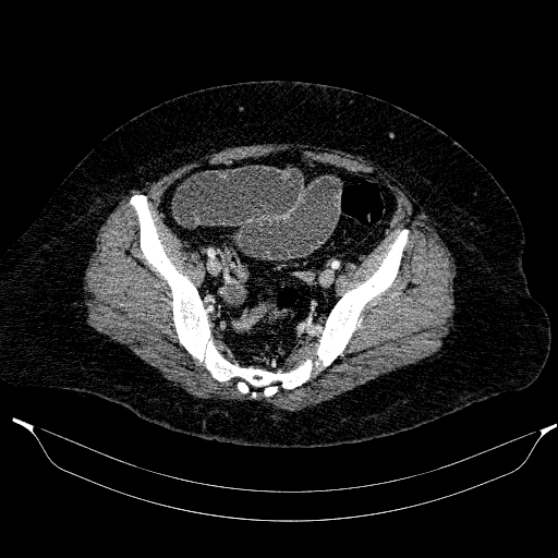 Afferent loop syndrome - secondary to incarcerated trocar site hernia (Radiopaedia 82959-97305 Axial C+ portal venous phase 193).jpg