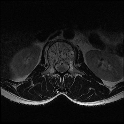 File:Aggressive vertebral hemangioma with pathological fracture (Radiopaedia 69528-79411 Axial T2 15).jpg