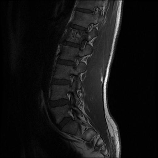 File:Aggressive vertebral hemangioma with pathological fracture (Radiopaedia 69528-79411 Sagittal T1 8).jpg