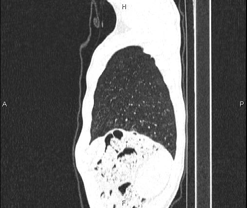 Air bronchogram in pneumonia (Radiopaedia 85719-101512 Sagittal lung window 91).jpg