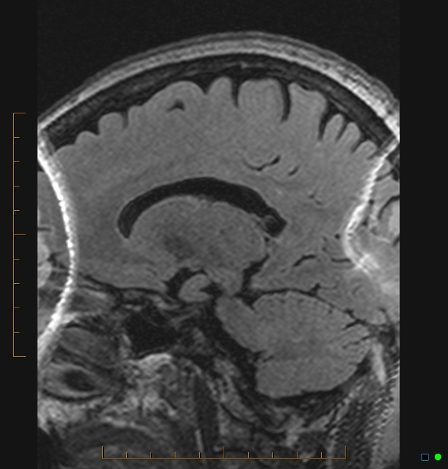 Aliasing artifact causing a spurious cerebellar lesion (Radiopaedia 48783-53810 Sagittal FLAIR 22).jpg