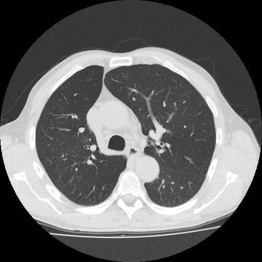 Allergic bronchopulmonary aspergillosis (ABPA) (Radiopaedia 60594-68313 Axial lung window 21).jpg