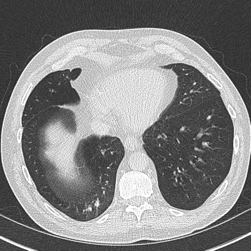 Allergic bronchopulmonary aspergillosis (Radiopaedia 44760-48571 Axial lung window 50).png