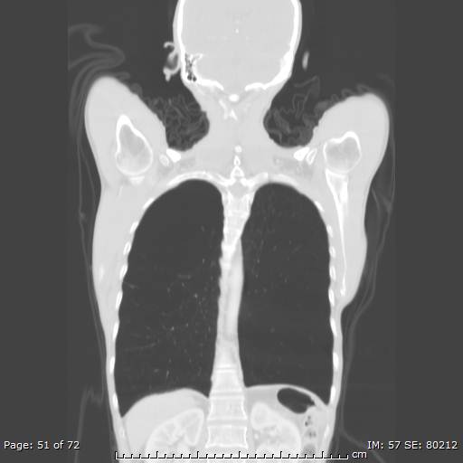 Alpha-1-antitrypsin deficiency (Radiopaedia 50561-55987 Coronal lung window 49).jpg