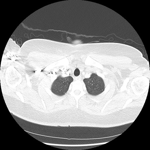 Alveolar soft part sarcoma - right leg (Radiopaedia 59432-67091 Axial lung window 14).jpg